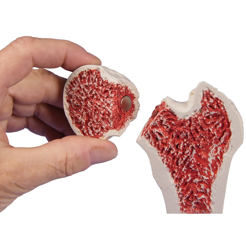 Osteoporoza stegnenice