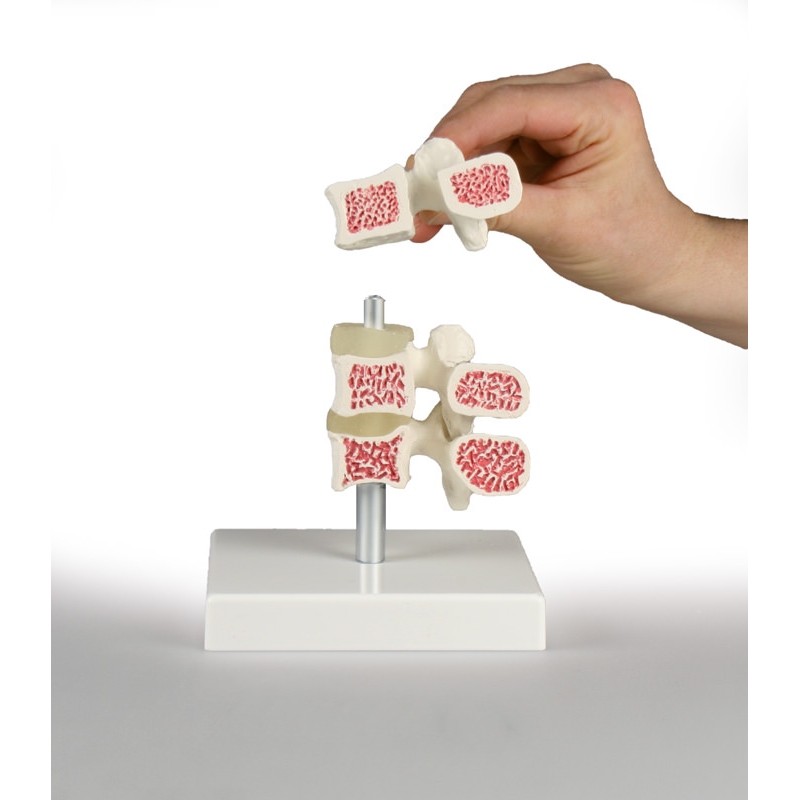 Model vretenc za osteoporozo, 3 vretenca