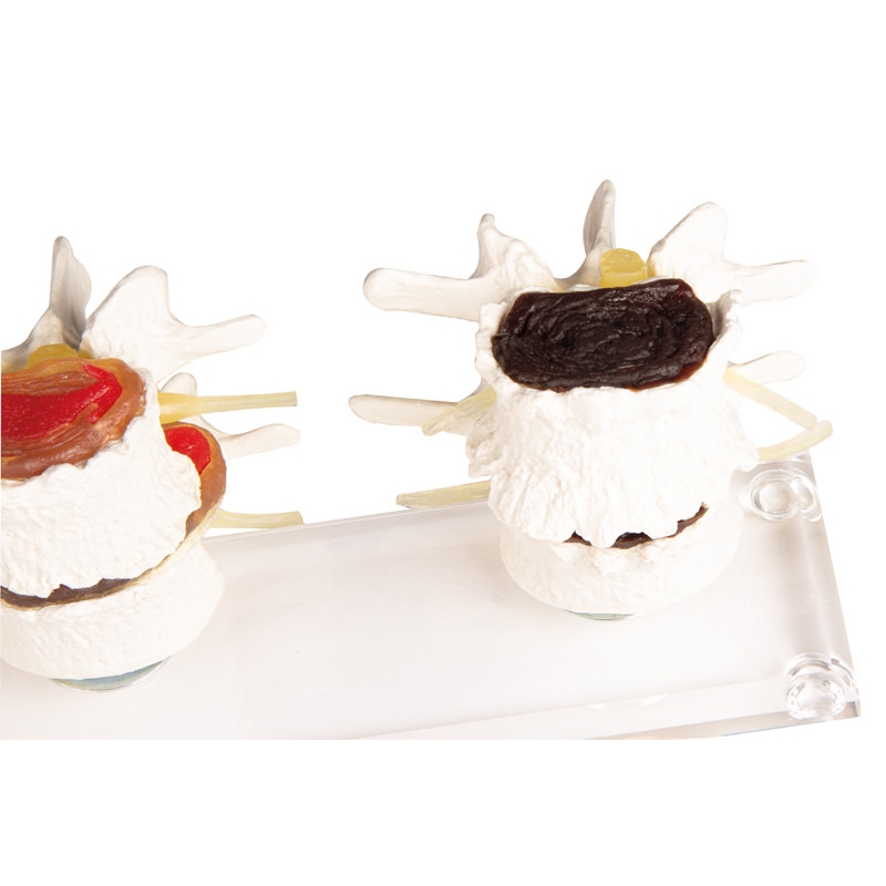 Stopnje degeneracije diska