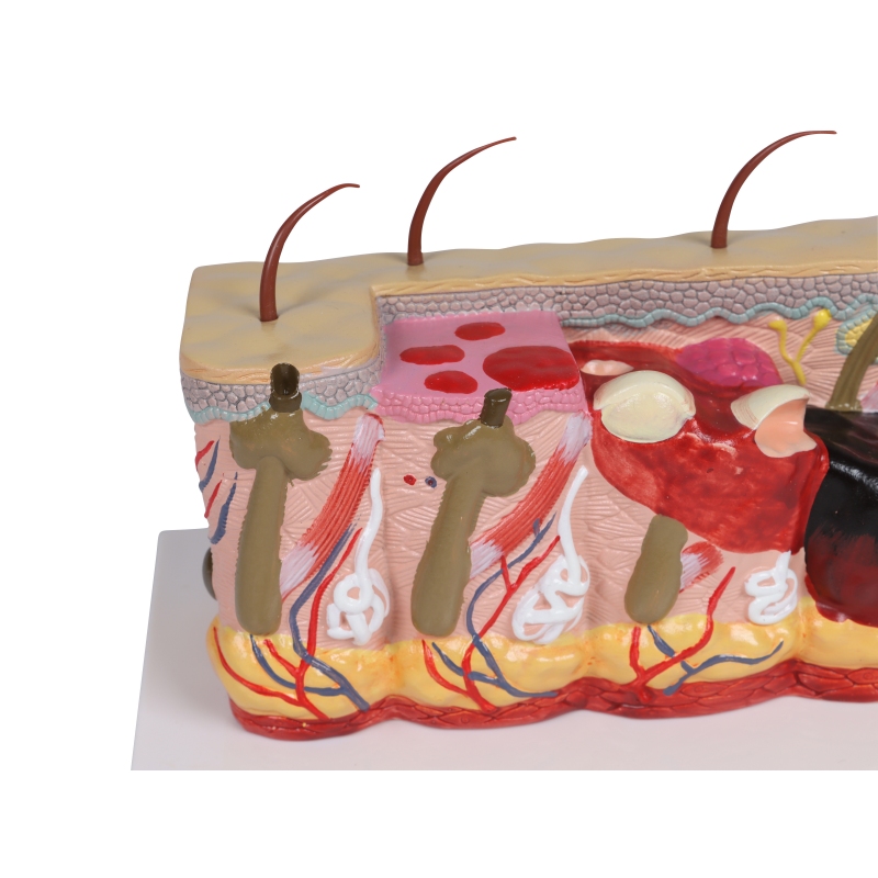Patološki model kože z opeklinami, 30-kratna velikost
