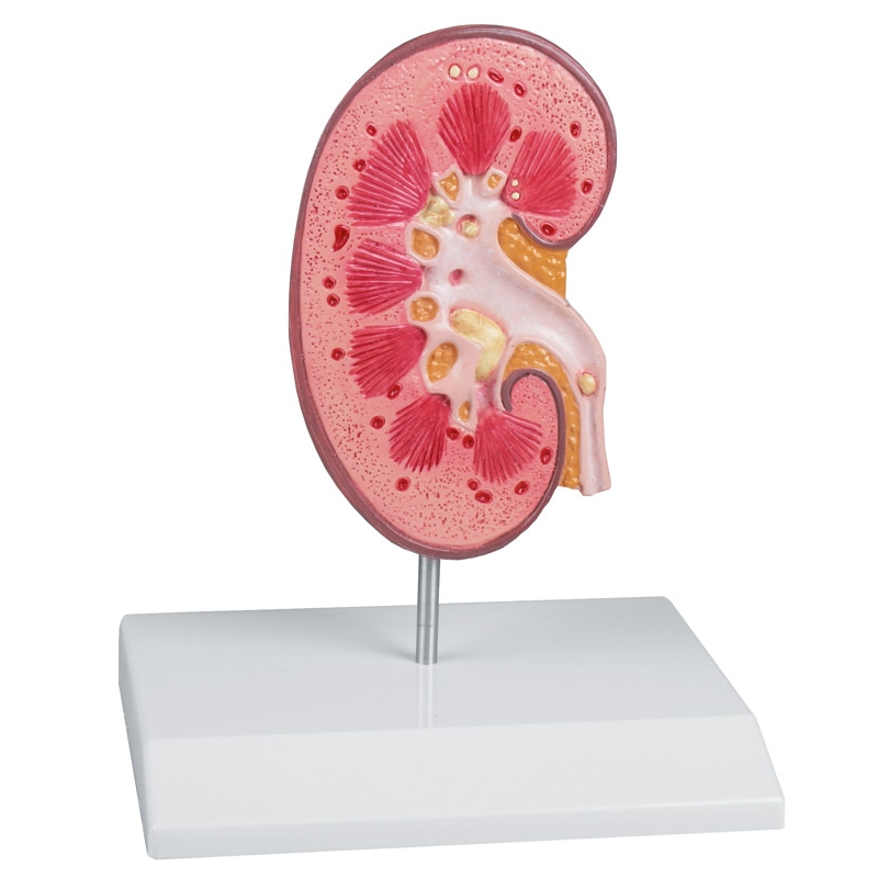 Model ledvičnega kamna - EZ Augmented Anatomy