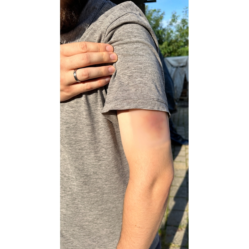 Mulaža rane Starejši hematom