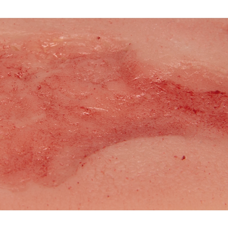 Mulaža rane venska razjeda na nogi, majhna, faza epitelizacije