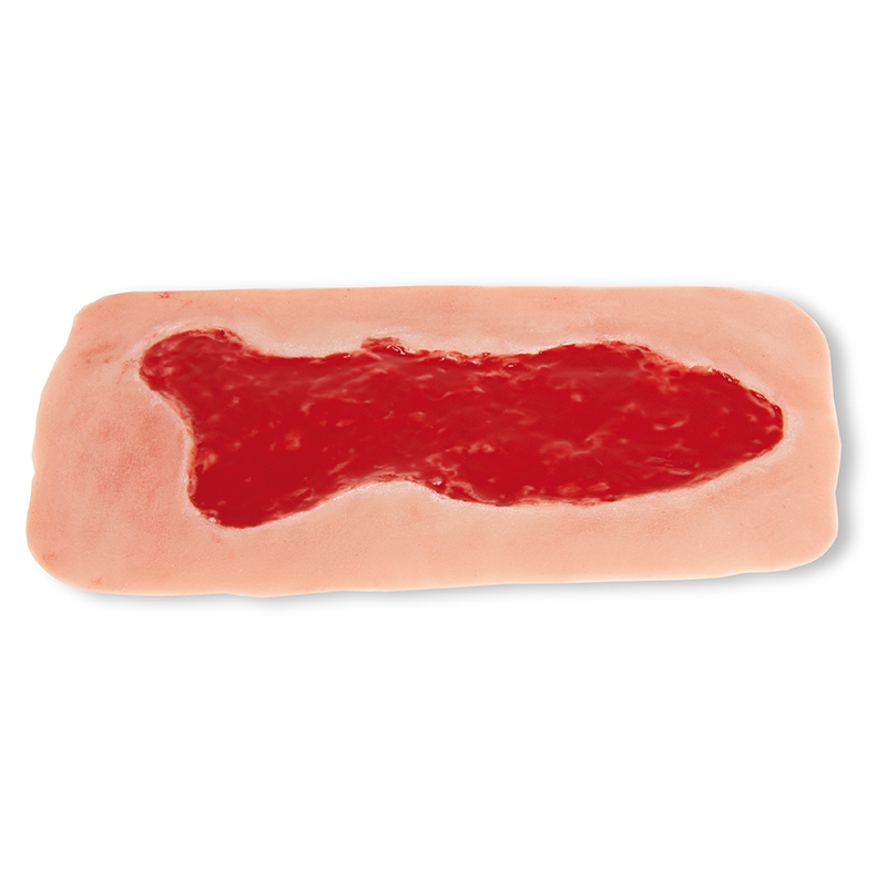 Mulaža rane venska razjeda na nogi, velika, faza granulacije