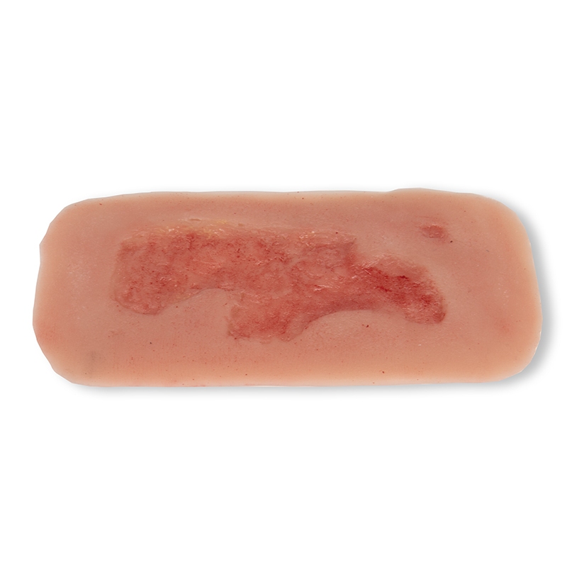 Mulaža rane arterijska razjeda na nogi, majhna, faza epitelizacije