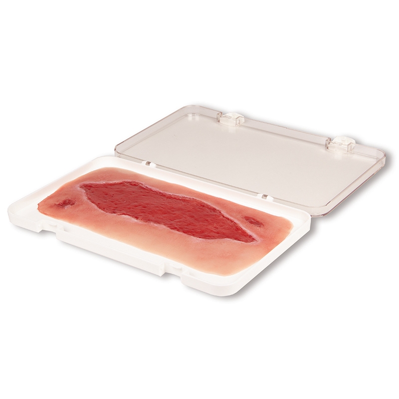 Mulaža rane arterijska razjeda na nogi, velika, faza granulacije