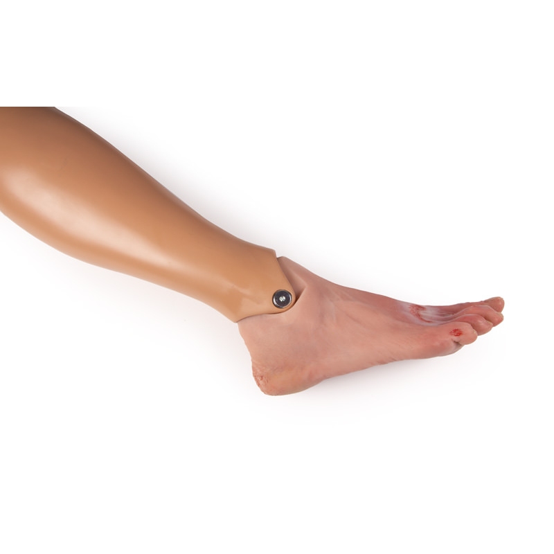 Rana stopala s sindromom diabetičnega stopala, huda stopnja, različica za preskusno lutko