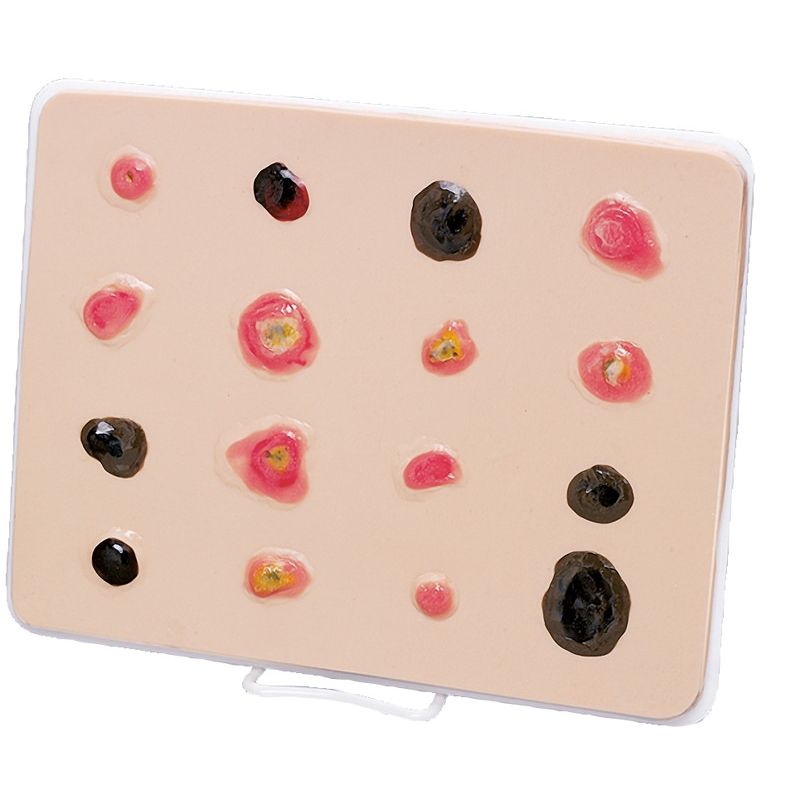 Trener belega kožnega raka - povečan