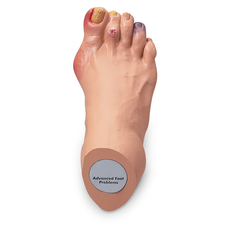 Napredne težave s stopali