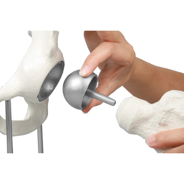 Kolčni sklep z vsadkom za obnavljanje