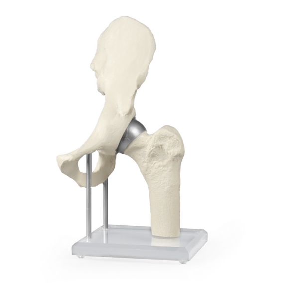 Kolčni sklep z vsadkom za obnavljanje