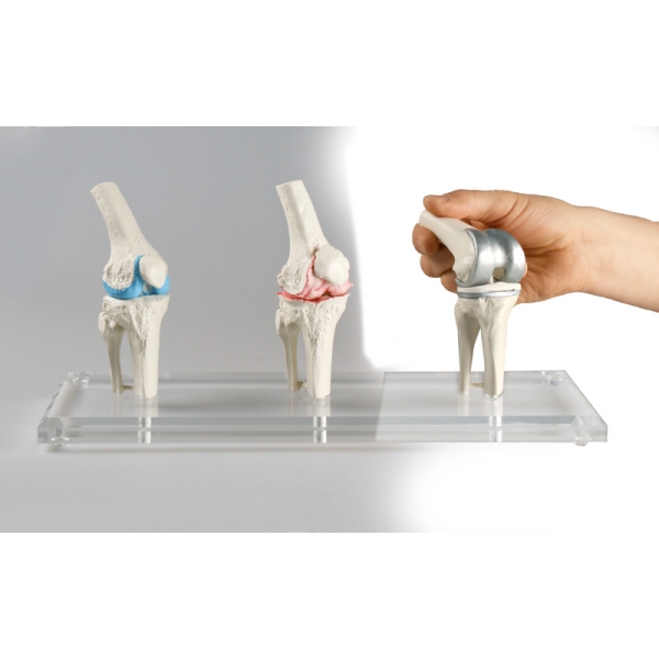 Kolenski model z implantantom