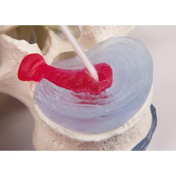 Ledvena vretenca s prolapsom medvretenčnih ploščic s stojiščem