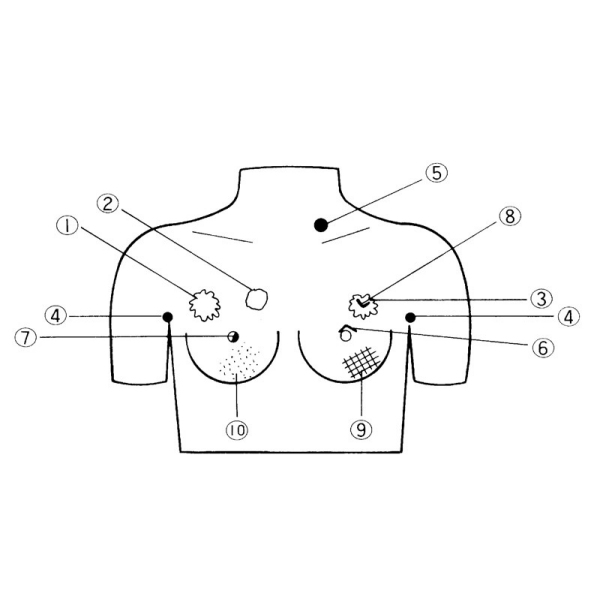 Model za palpacijo raka dojk