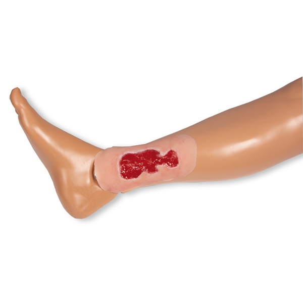 Mulaža rane venska razjeda na nogi, majhna, faza granulacije