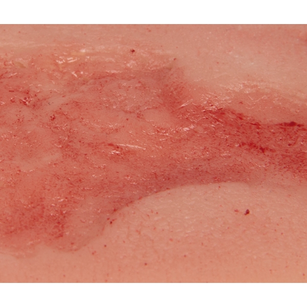 Mulaža rane venska razjeda na nogi, majhna, faza epitelizacije