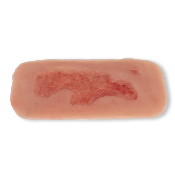 Mulaža rane arterijska razjeda na nogi, majhna, faza epitelizacije