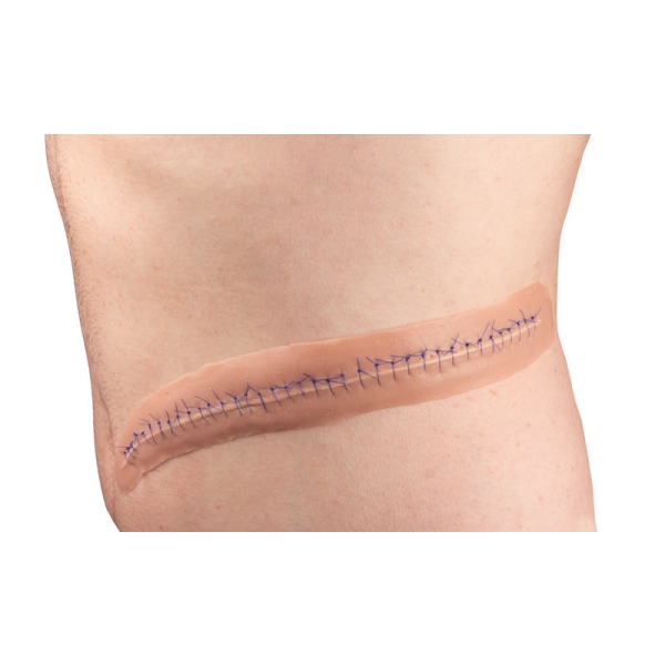 Kirurška rana s šivom, 22 cm