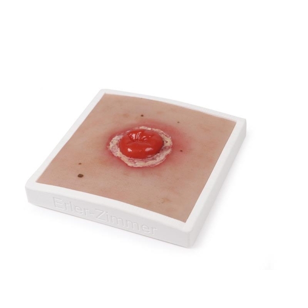 Mulaža rane Kolostoma z vnetjem, vključno s stojalom