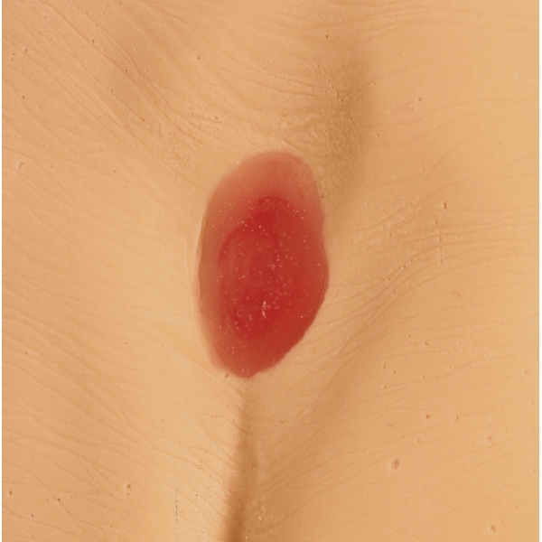 Modeli razjede zaradi pritiska / preležanin