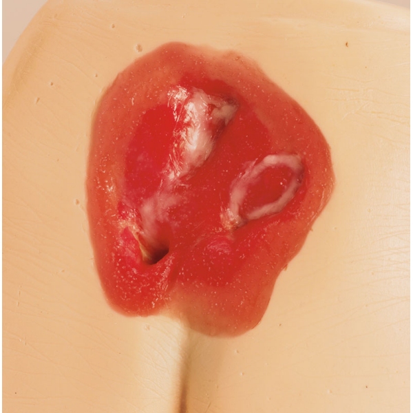 Modeli razjede zaradi pritiska / preležanin