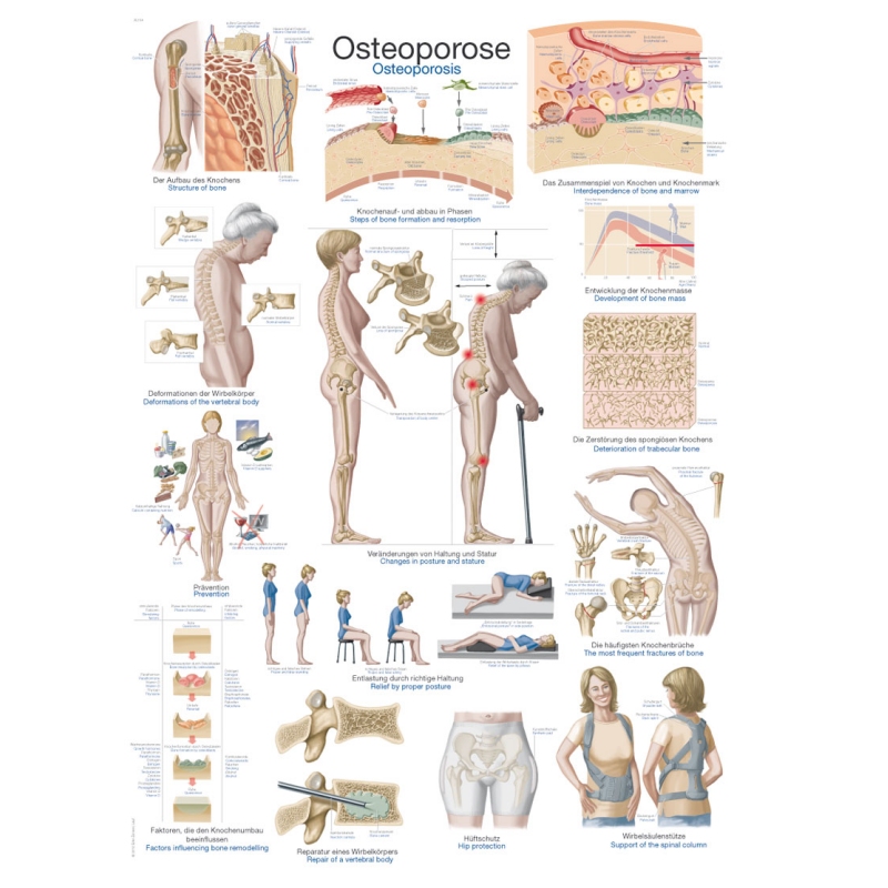 Diagram Osteoporoza, 70x100cm (Angleški)