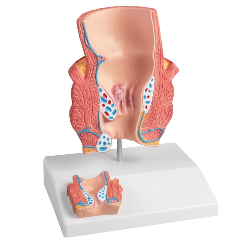 Model hemoroidov