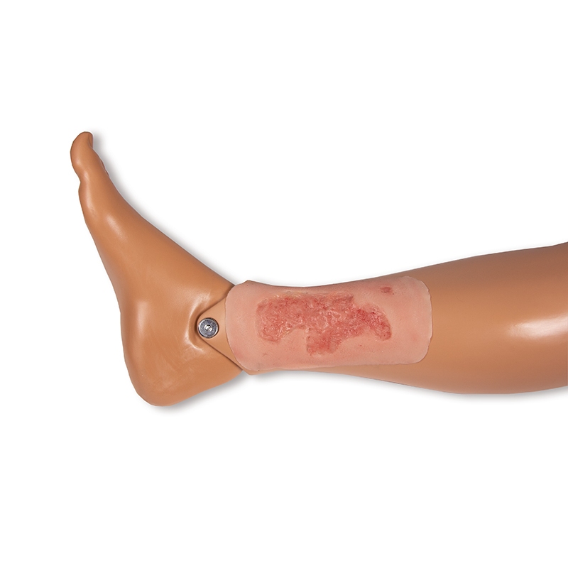 Mulaža rane arterijska razjeda na nogi, majhna, faza epitelizacije