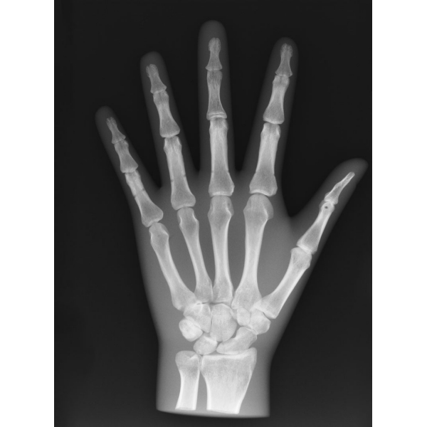 X-Ray Phantom Hand, neprozoren