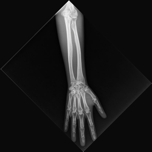 X-Ray Phantom Spodnji del roke, neprozoren