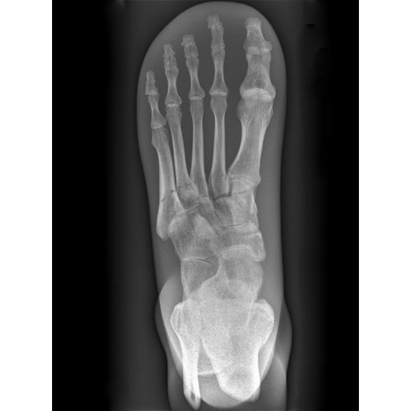 X-Ray Phantom Foot, neprozoren